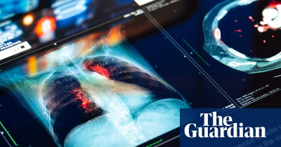 The Guardian-Cancer cases in under-50s worldwide up nearly 80 in three decades study finds